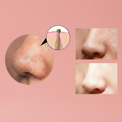 Skinnia: Čistič Pórů