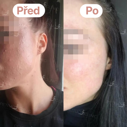 Skinnia: Čistič Pórů