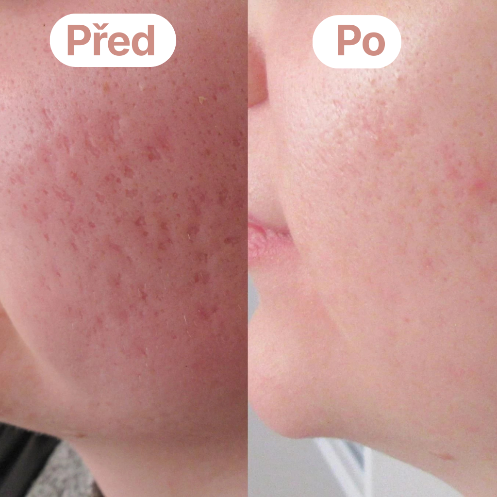 Skinnia: Čistič Pórů
